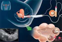 代孕网-代孕网哪家好-代孕多久会有孕吐反应